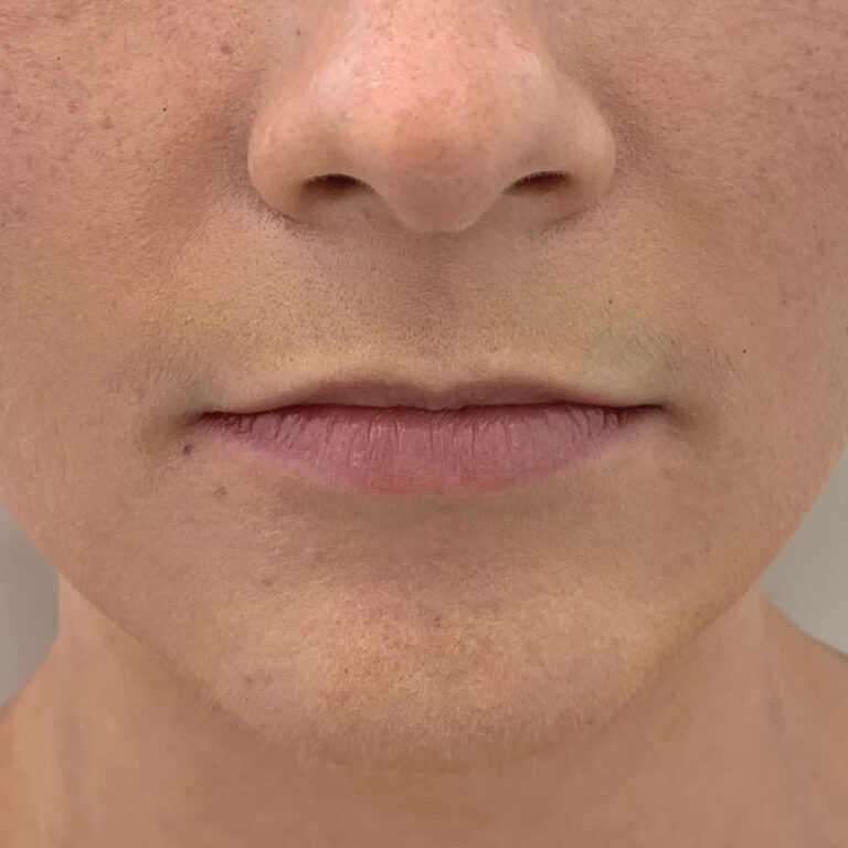 Aumento de labios, antes