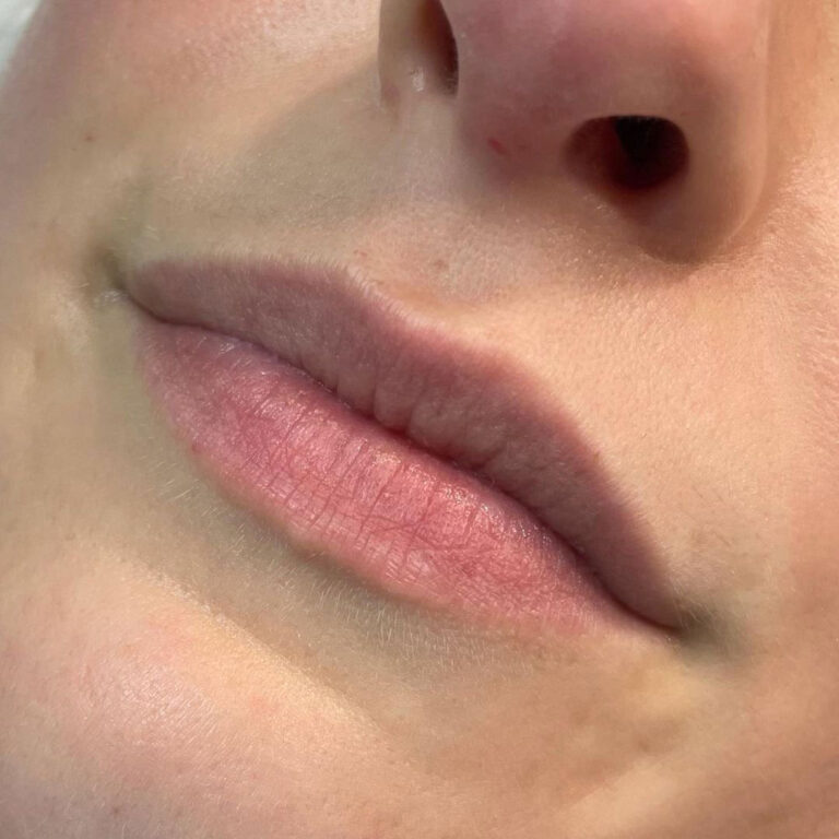 Aumento de labios, antes