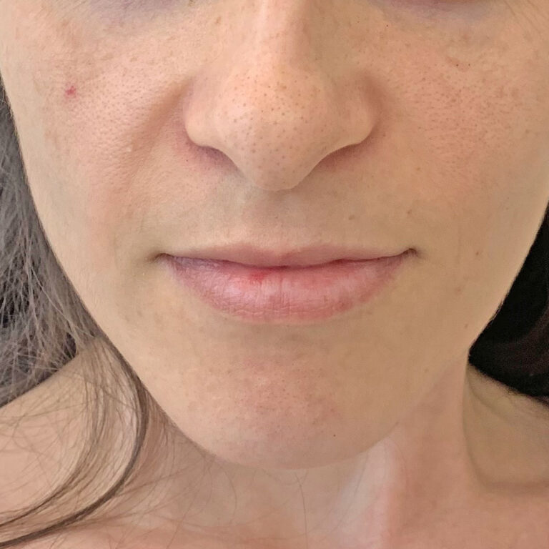Aumento de labios, antes