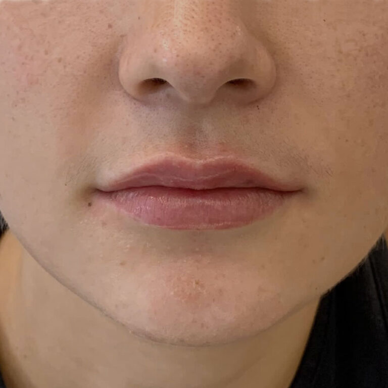Aumento de labios, después