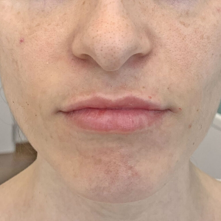 Aumento de labios, después