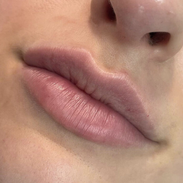 Aumento de labios, después