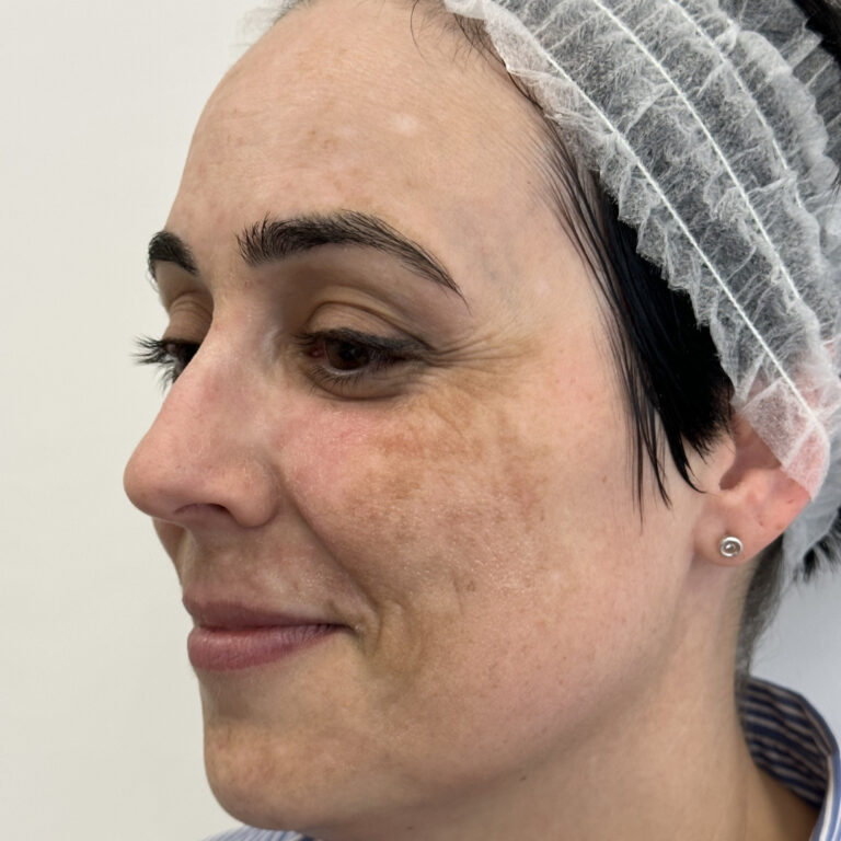 Tratamiento láser facial