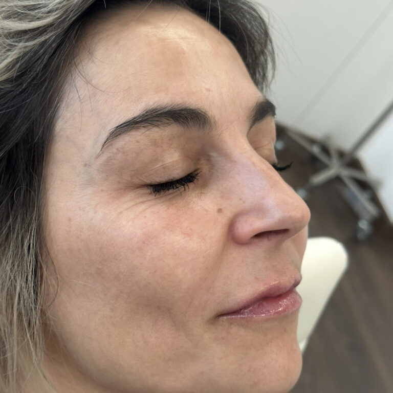 Tratamiento láser facial