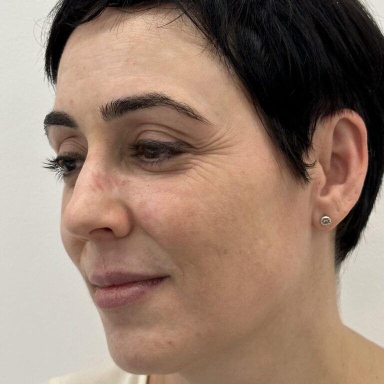 Tratamiento láser facial