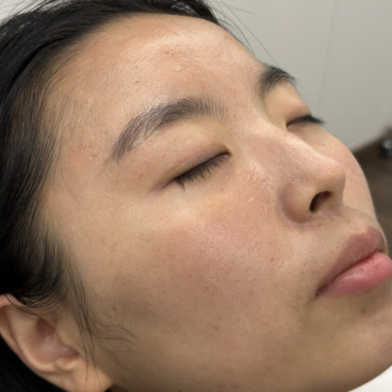 Tratamiento láser facial