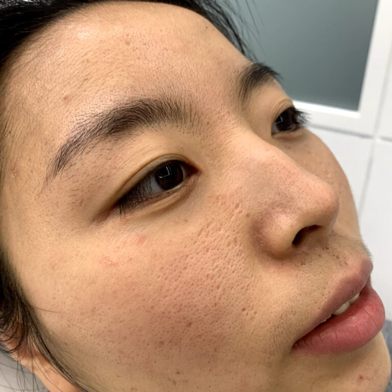 Tratamiento láser facial